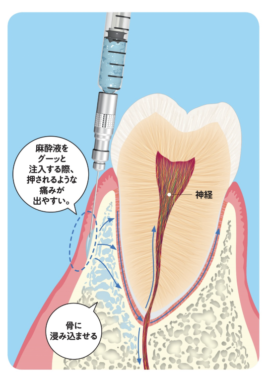 局所麻酔